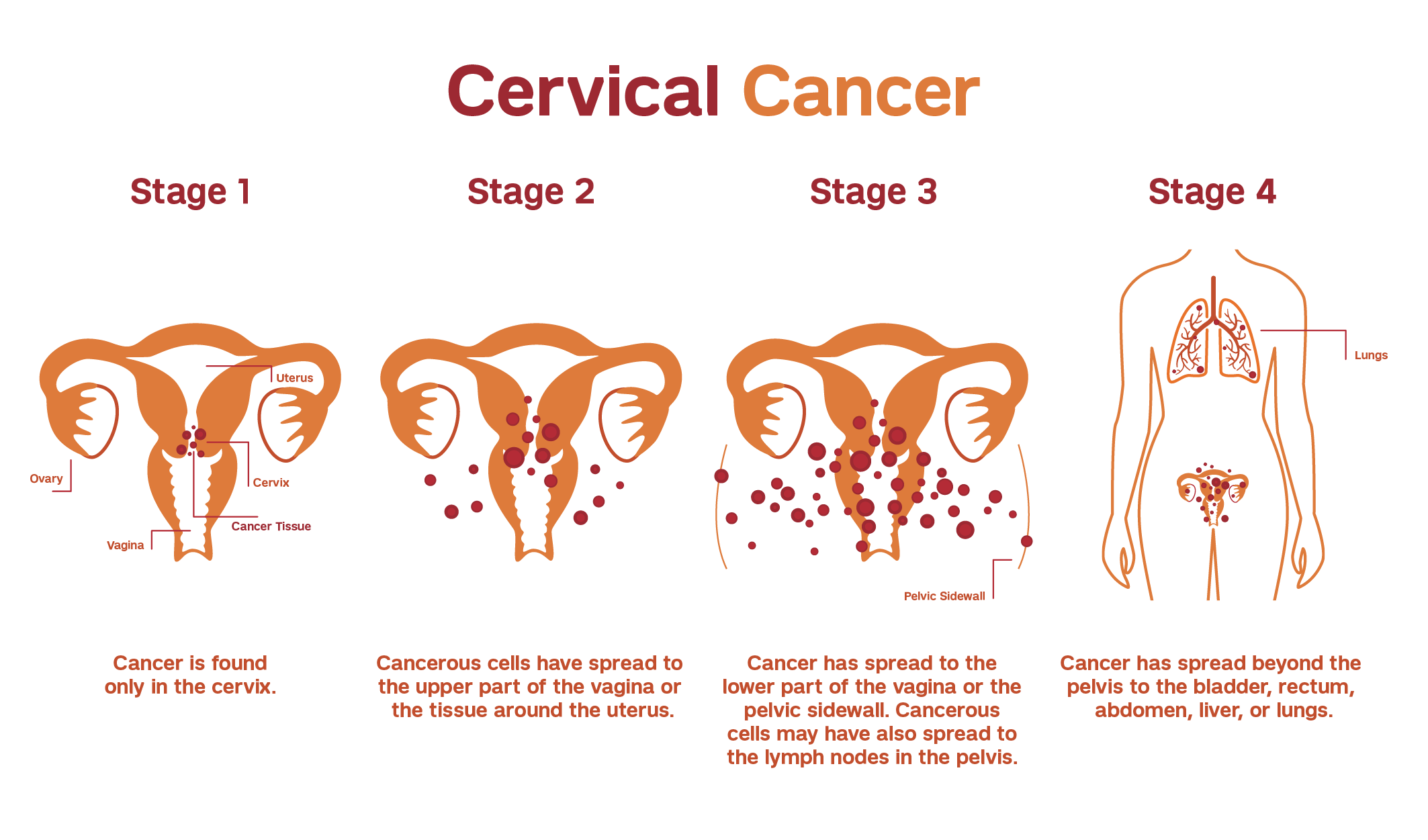 Illustration explaining the staging of cervical cancer