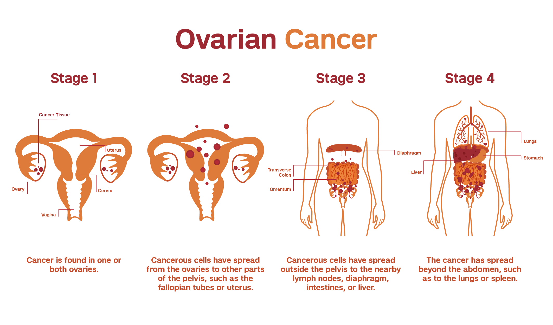 Ovarian Cancer Patient Care 2777