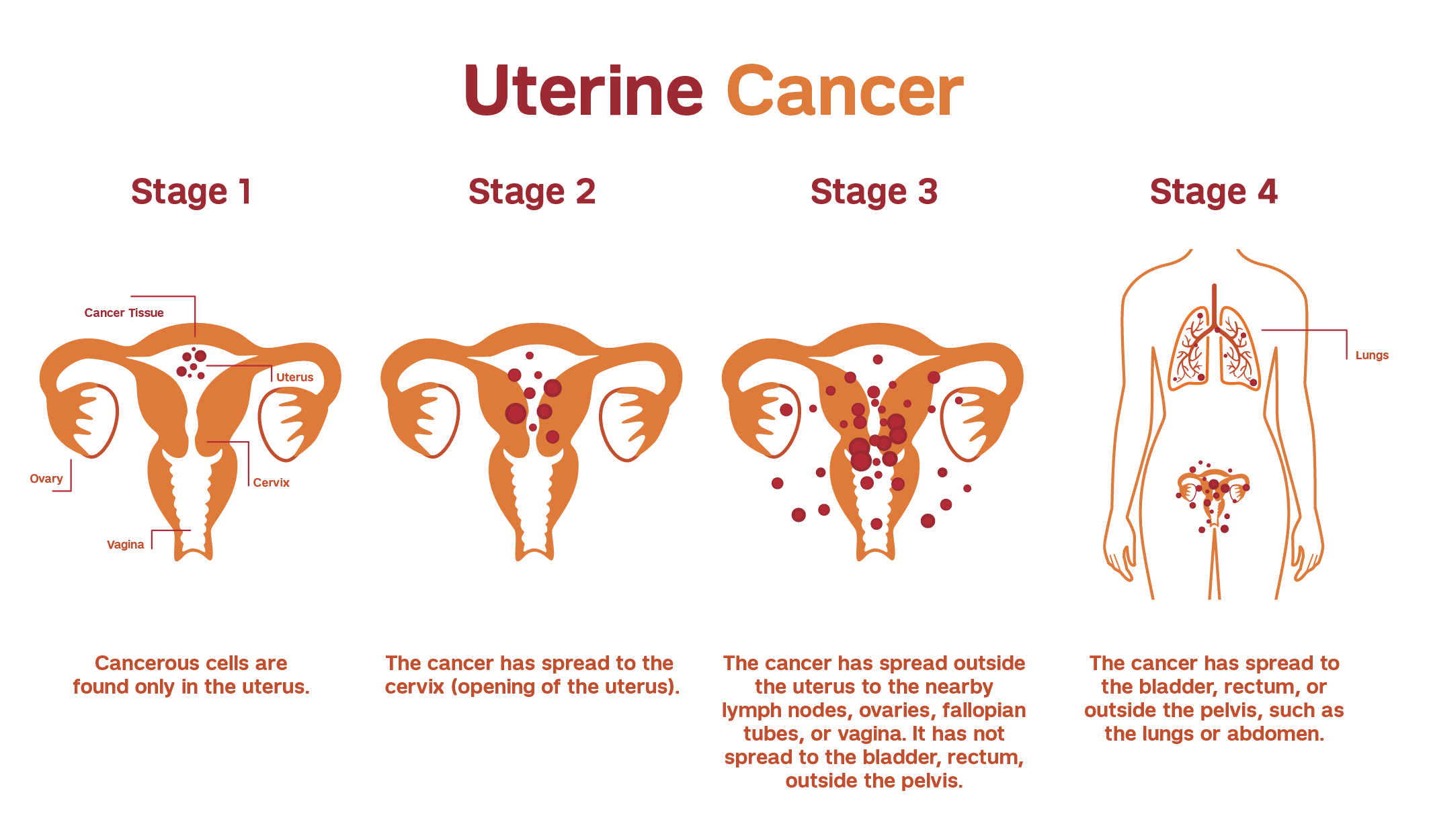 Illustration explaining the staging of endometrial and uterine cancers