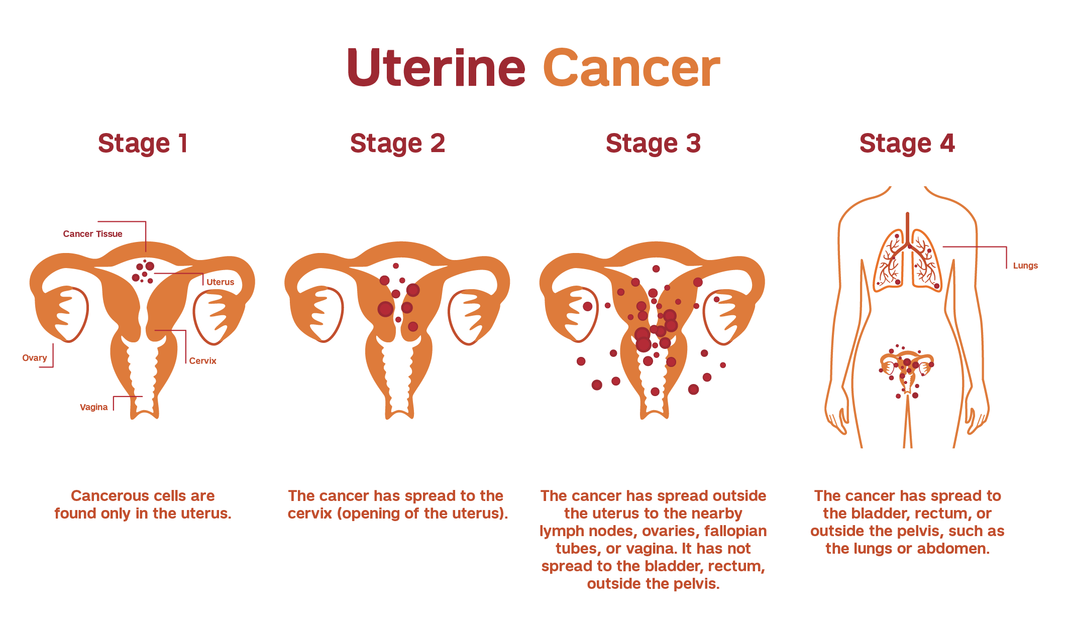 endometrial cancer symptoms