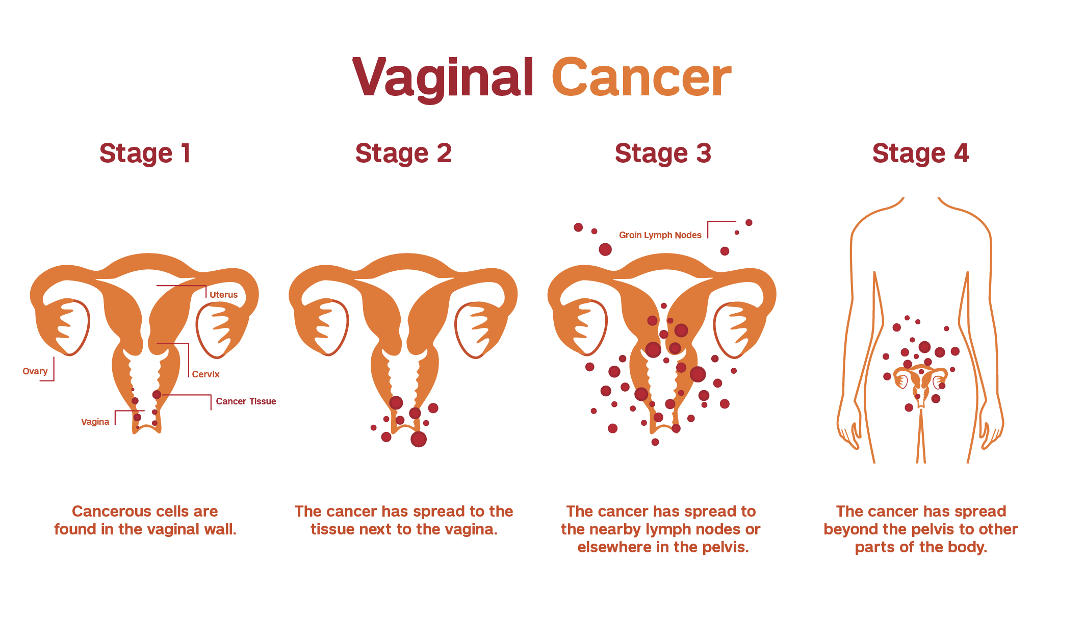 Illustration explaining the staging of vaginal cancer