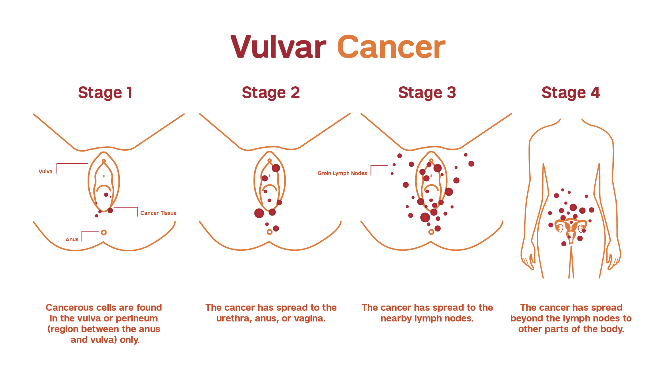 Illustration explaining the staging of vulvar cancer