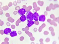 Acute myeloid leukemia cells under a microscope