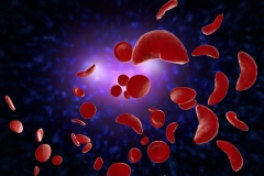 sickle cell disease