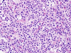 Haematolymphoid Tumours. Myeloproliferative neoplasms.