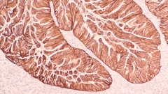 Stomach Cancer Pathology Research: Immunohistochemistry for HER2 shows positive cell membrane staining in this gastric adenocarcinoma. Targeted therapy with Herceptin (trastuzumab) may be beneficial.