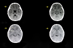 Brain scan that shows a subdural hematoma.